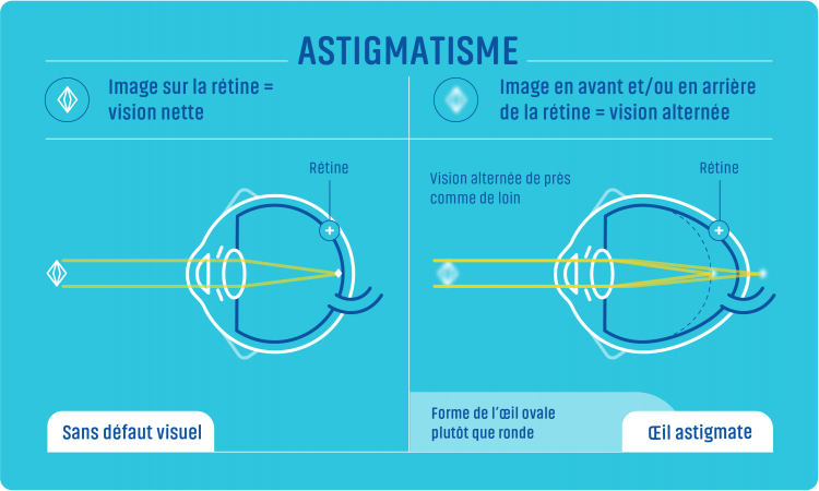 Astigmatie Marseille 13012 H l na Guigue Ophtalmologue Marseille 13012