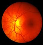 retinopathie diabetique